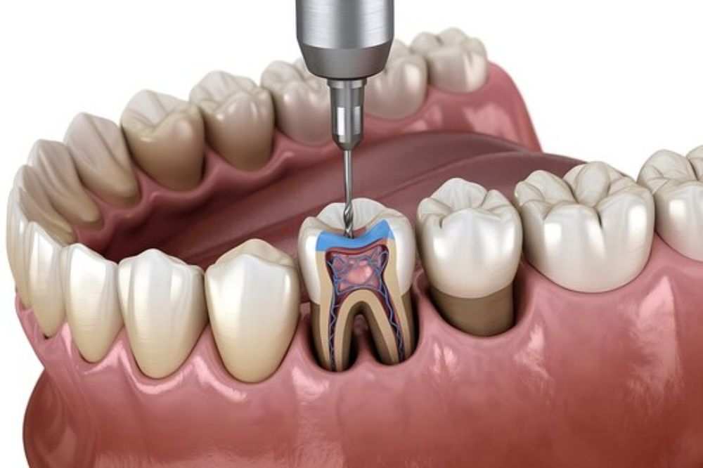 root canal in Los Angeles