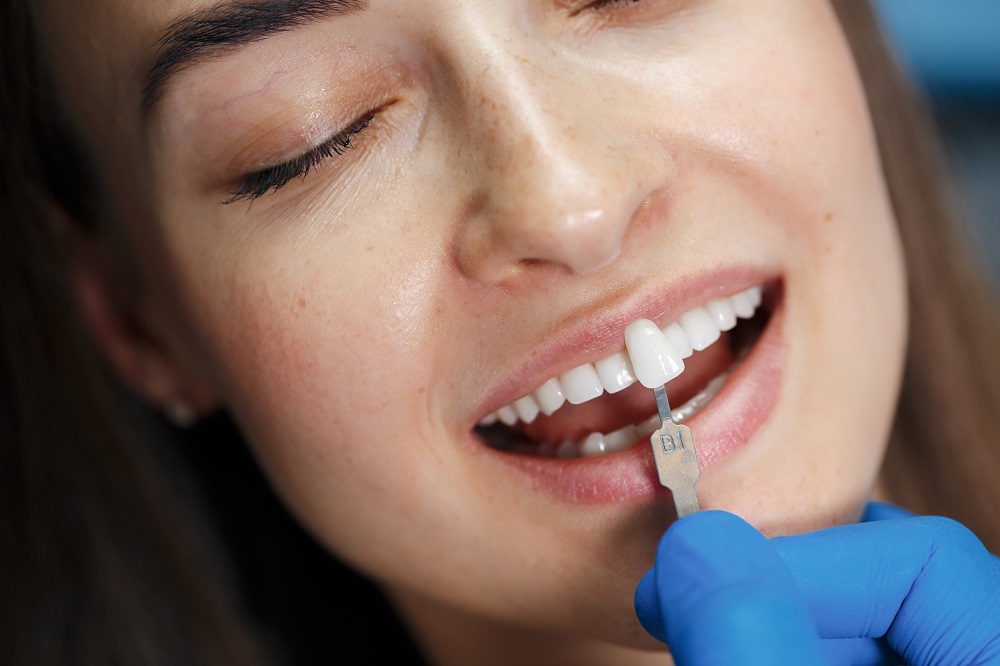 Veneers Palmdale