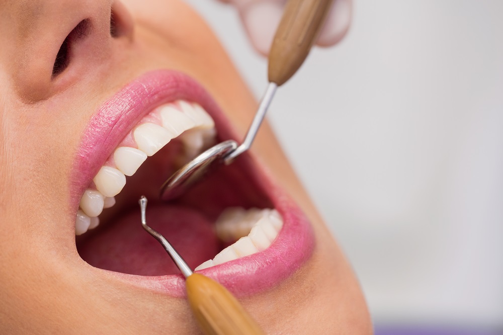 Veneers cost in Palmdale